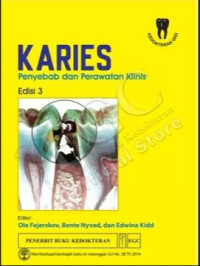 Image of karies : penyebab dan perawatan